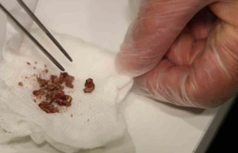 Elazığ'da estetik ameliyatta şaşırtan olay, burundan taş çıktı