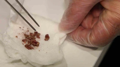 Elazığ'da estetik ameliyatta şaşırtan olay, burundan taş çıktı