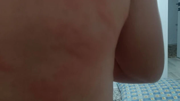 Elazığ'da böcek ısırığı hastanelik etti