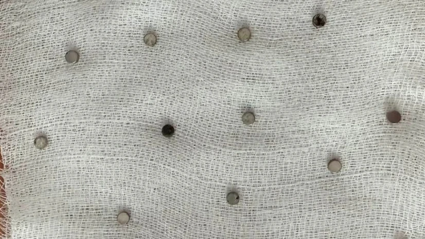 Çocuğun boğazından 19 adet mıknatıs çıkartıldı